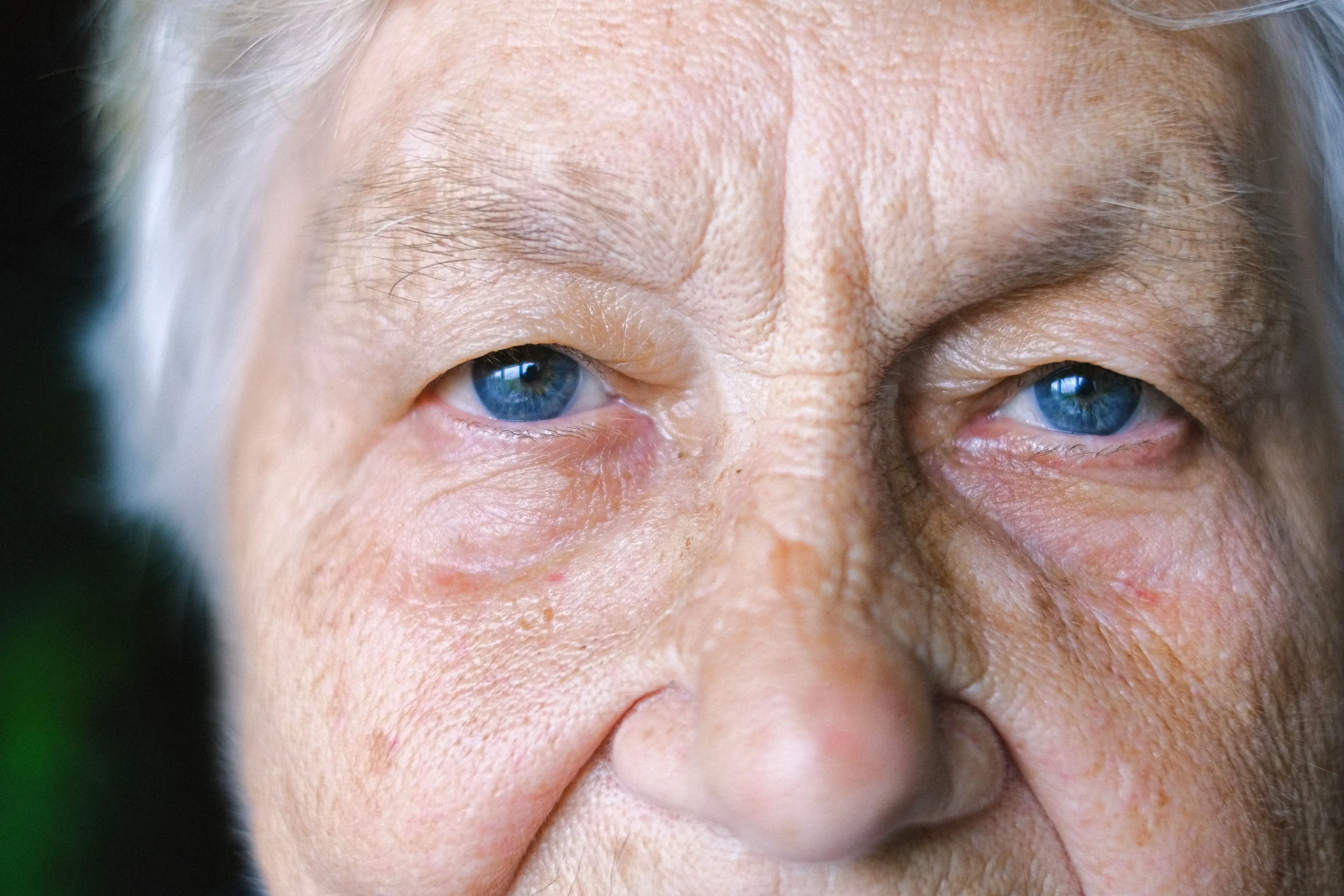 Persona en el grupod de riesgo de Glaucoma